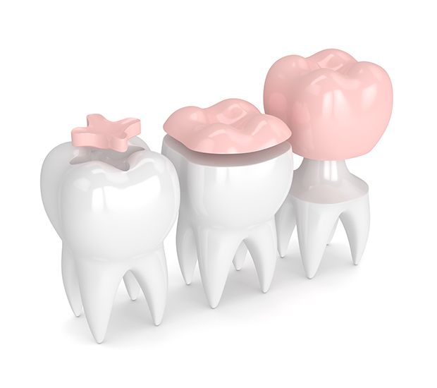 Independence Dental Inlays and Onlays